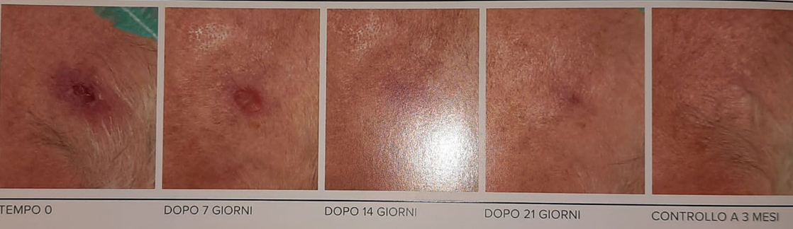 Tumori non melanoma